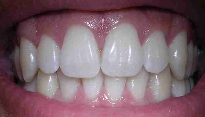 Idrossiapatite e salute dei denti chimicamo e1617205947139
